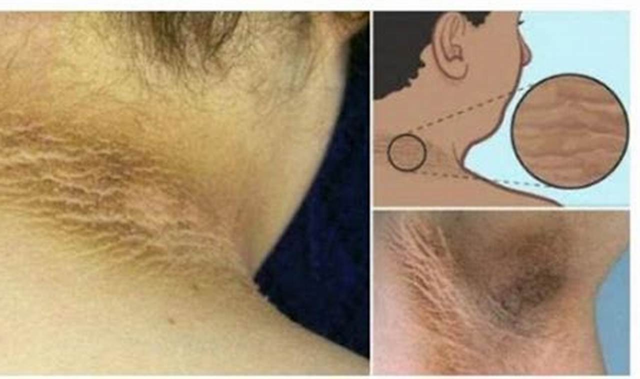 Cara Mengatasi Ketiak Hitam